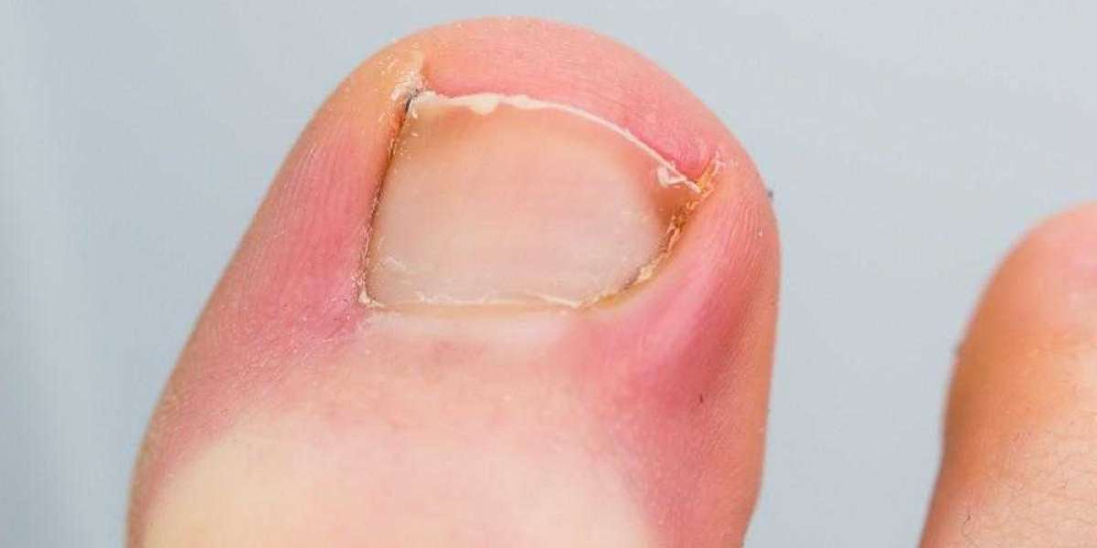 urgent care ingrown toenail removal