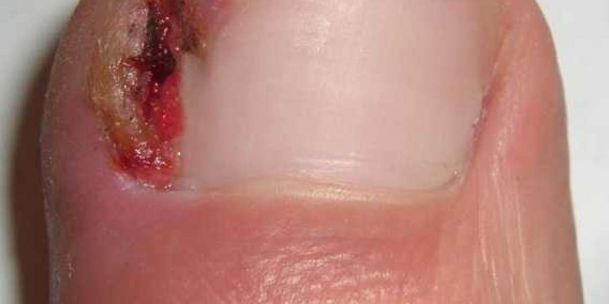 Urgent Care Ingrown Toenail Near Me