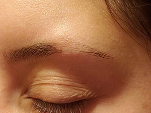 Homeopathic Medicine for Eyebrow Hair Loss Treatment in India