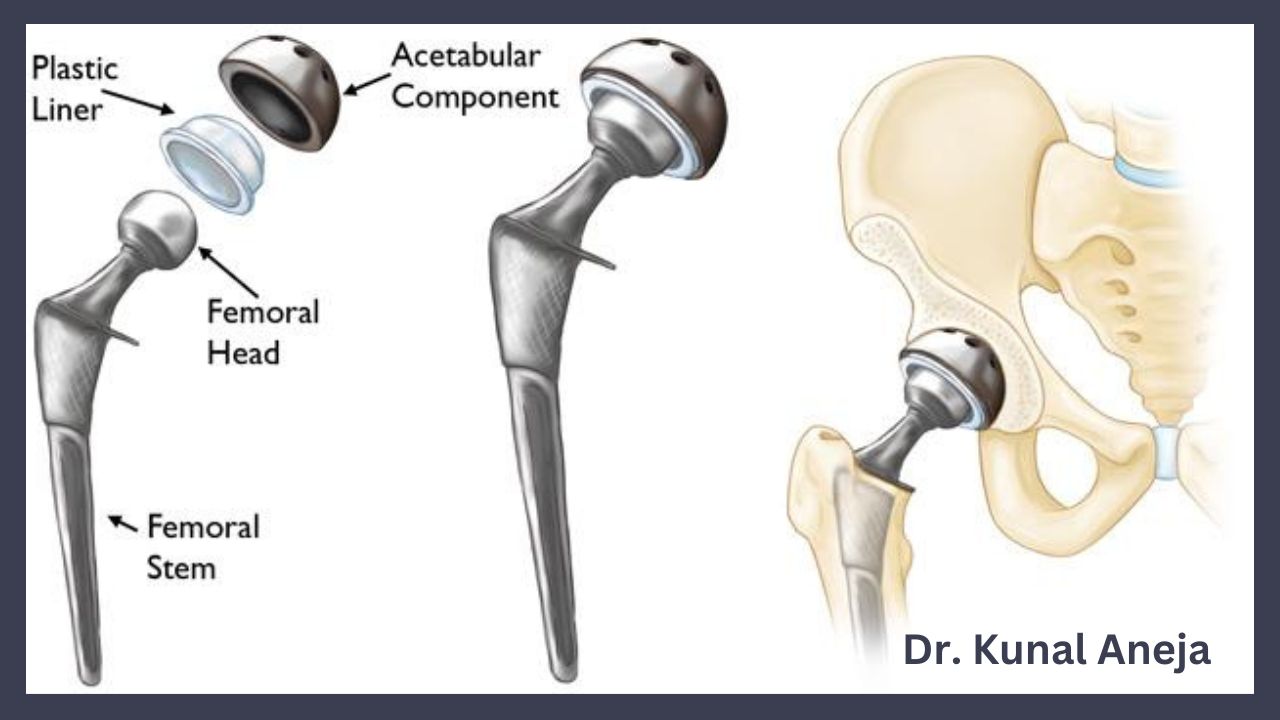 Best Hip Replacement Surgeon in Delhi- Dr. Kunal Aneja