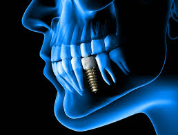 The Long-Term Benefits of Dental Implants for Oral Health