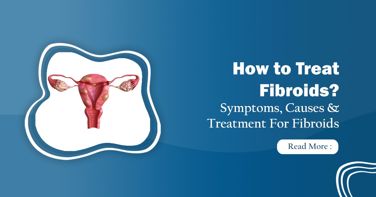 Fibroids Treatment – Causes, Symptoms & Best Treatment Guide