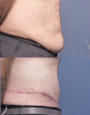 Belt Lipectomy Surgeon Brisbane - Dr Raymond Goh