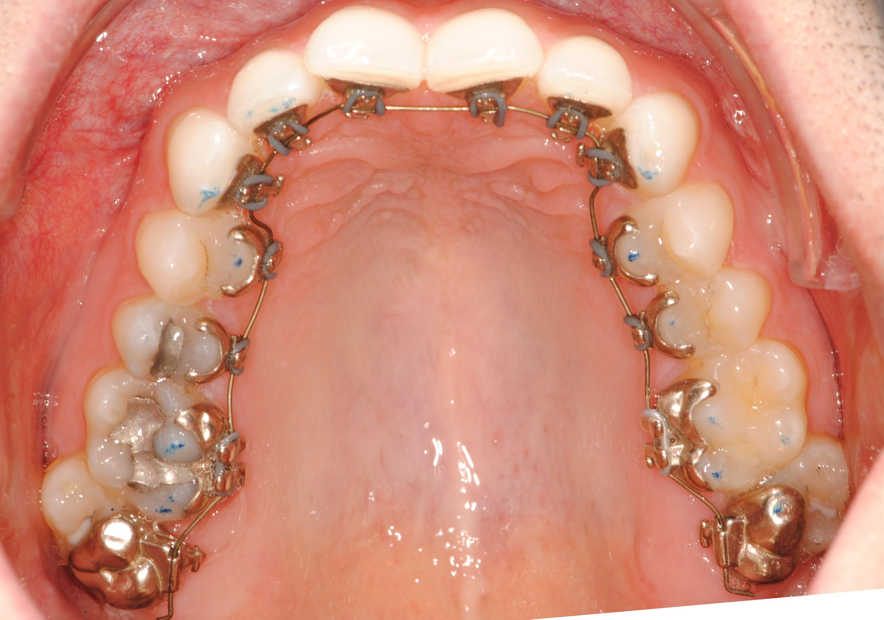 Incognito Braces Cost- Masri Orthodontics Services